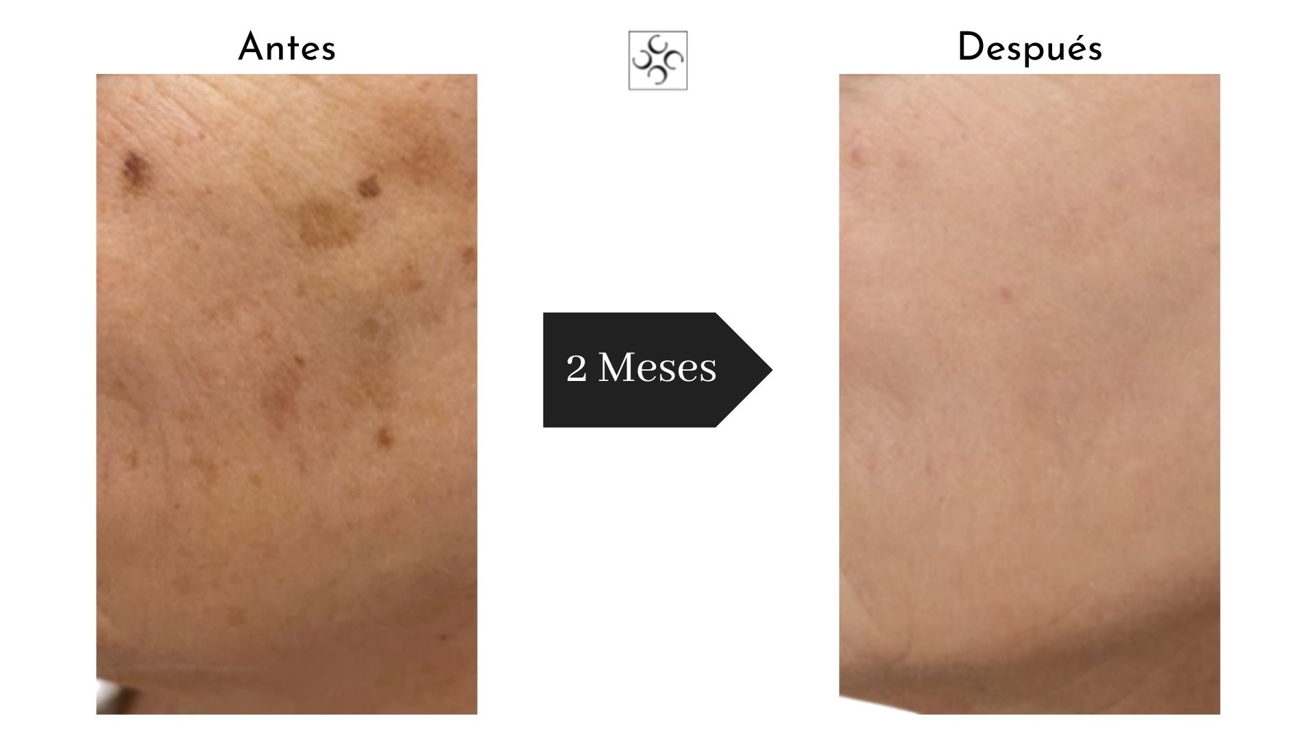 ¿Melasma o mancha solar?