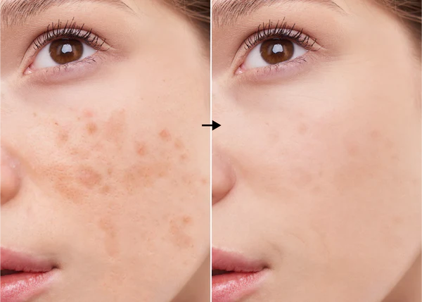 Ácido Kójico 2% de la marca Universkin: Resultados