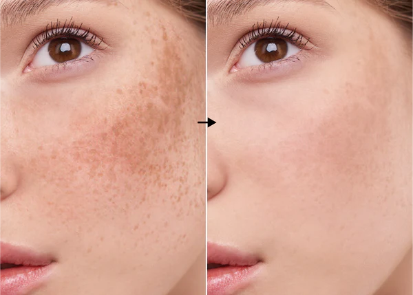 Arbutina 3% de la marca Universkin: Resultados