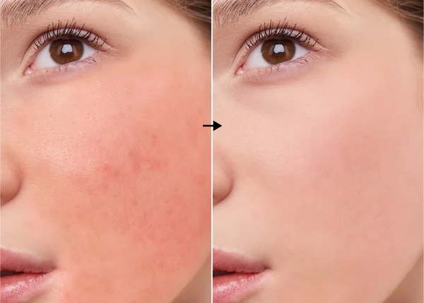 SOD 2% de la marca Universkin: Resultados