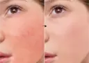 SOD 2% de la marca Universkin: Resultados